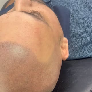 Natural broken down hairline! Once the ink settles it will look completely natural and undetectable.
