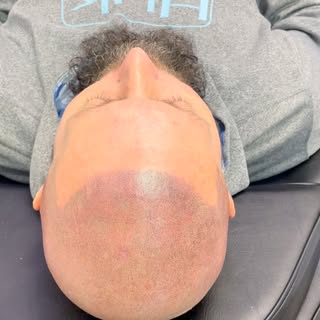 From Bald to Bold. Completely natural looking and undetectable once fully healed. 
.
.
.
#smpink #sa