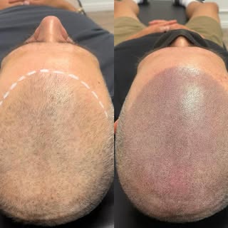 I know how it feels to struggle with hair loss especially at a young age. Six years ago, I made the 