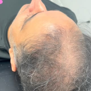 ✨ Scalp Micropigmentation (SMP) isn’t just for bald heads it can enhance the hair you already have.
