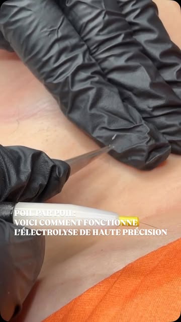 L’électrolyse de haute précision: la solution ultime quand le laser atteint ses limites. ⚡️

Pour le