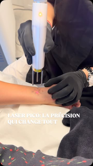 Un tatouage n’est pas figé dans le temps. Il évolue, comme vous.

Le laser picoseconde ne « gomme » 