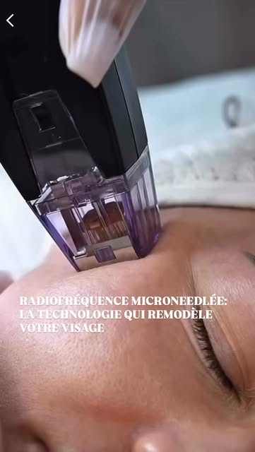 Le Morpheus8 associe deux technologies en une seule séance: des micro-aiguilles qui pénètrent jusqu’