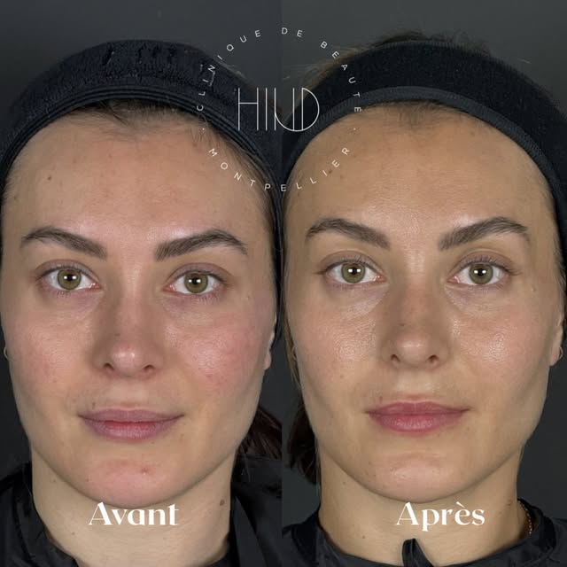 ✨Avant/Après 3 soins Exosomes avec Microneedling et cosmétiques sur mesure. ✨

#qualitédepeau #rouge