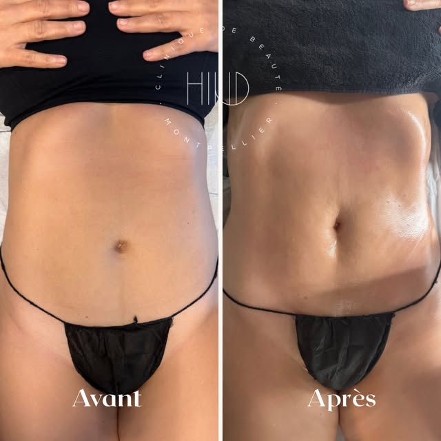 ✨Avant/Après une séance de drainage lymphatique✨

#drainagelymphatique #retentiondeau #ventregonflé 