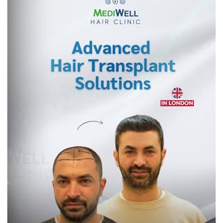 Advanced Hair Transplant Solutions, in the heart of London.

At Mediwell Hair Clinic, we combine mod