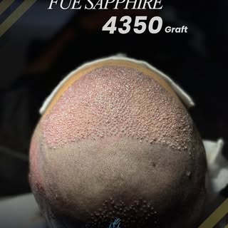 The procedure may be complete, but every graft still has a role to play.

Following this 4,350 graft