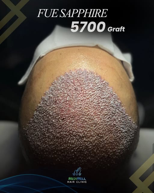 A closer look at the work beneath the numbers.

With the procedure complete, the newly implanted gra