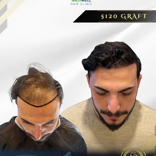 A transformation that speaks for itself.

With 5,120 grafts placed using the Hybrid technique, the f