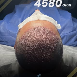The work behind the result, captured at its earliest stage.

Immediately after implantation, every g