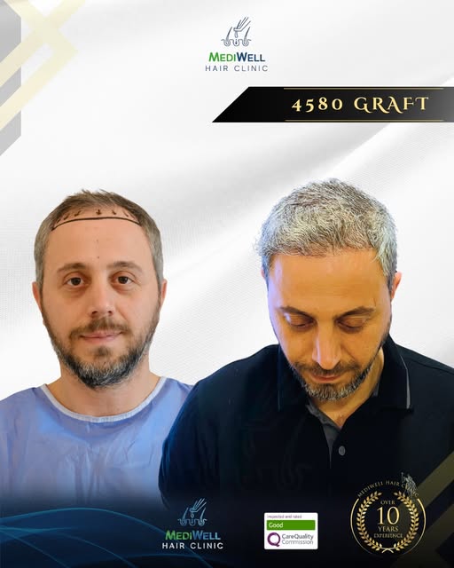 The difference reveals itself over time.

Following a 4,580 graft Hybrid Hair Transplant, the result