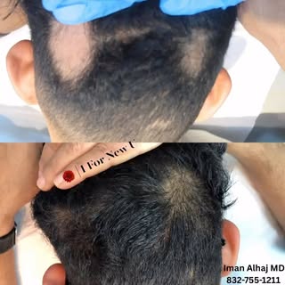 Hair restoration isn’t just a procedure — it’s a transformation when done correctly by experienced h