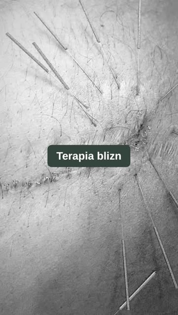 Wygląda strasznie i boleśnie? 😳 A to kompleksowa terapia blizny.

Na zdjęciach jeden z jej etapów, 