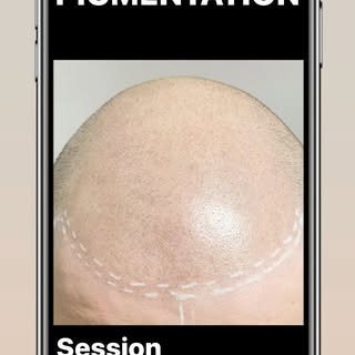 Scalp micro pigmentation 6 months healed 

#smp #scalpmicropigmentation #healedresults #naturalhair 