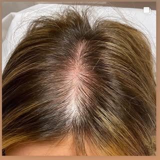 Swipe ➡️ to see the results of scalp micro pigmentation female density treatment

📍Wakefield
▪️Full