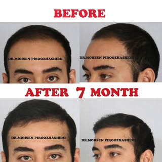 .
.
.
#Before_and_After of #Hair_Transplantation at #Gandhi_Hospital's Hair Transplant Clinic by #Dr