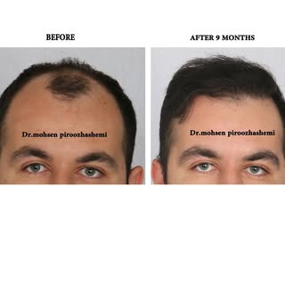 .
.
.
#transplant #hair_transplant #hair_restoration #natural_hair_transplantation #eyebrow_transpla
