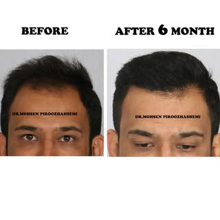 .
.
.
#Before_and_After of #Hair_Transplant at #Gandhi_Hospital's Hair Transplant Clinic by #Dr._Moh
