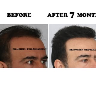 .
.
.

#change #beautiful #beauty #Self_confidence  #change#youth #Tehran #Iran #Hair_Loss #Hair_Car