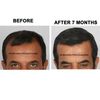 .
.
.
#Hair_transplant #Nutrition #Surgery #beautiful #Beauty #Youth #Rejuvenation #change #Health #
