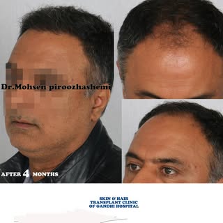.
.
.
#Hair_Transplantation #prp #mezotrapi #Nutrition #Surgery #beautiful #Beauty #Rejuvenation #ch