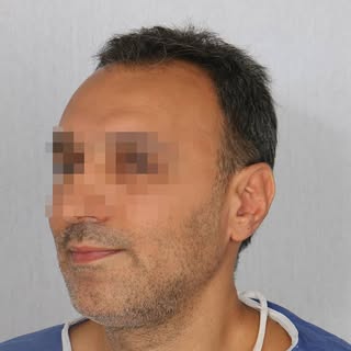 .
.
.
Before and after of hair transplant a at Gandhi Hospital Natural Hair Transplant Clinic
#Chang