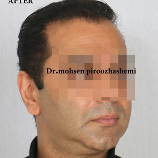 .
.
.
After 6 months😍😍 #self_confident #hair_style
#hair_loss #men's_baldness #relaxed #alopecia #
