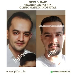.
.
.
#hairtransplant #hairrestoration
 #hairtransplantsurgery #prp #hairloss #fit #fue #fut #beard_