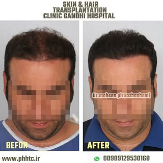 .
.
.
#befor_and_after of hair transplantation  by doctor #mohsen_piroozhashemi in natural hair tran