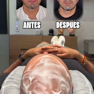 Un cambio que se nota, pero parece natural. 👌🏼
Antes vs. después de una micropigmentación capilar 