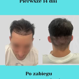 Każdy proces gojenia ma swój czas i tak jest po zabiegu przeszczepu włosów .

W przypadku zabiegu pr