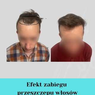 Zabieg przeszczepu włosów to długa procedura medyczna, a oczekiwanie na wzrost włosów trwa jeszcze d