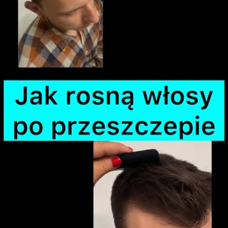 Proces wzrostu włosów po zabiegu przeszczepu trwa 12 miesięcy.

W pierwszych tygodniach włosy wypada