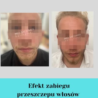 Zabieg przeszczepu włosów w okolice brody to procedura medyczna, która przeprowadza lekarz.

Zabieg 
