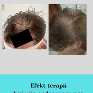 EFEKT TERAPII MEDYCZNEJ 
ŁYSIENIA ANDROGENOWEGO 

OPIS PRZYPADKU:
✔️ pacjent lat 27
✔️problem łysien
