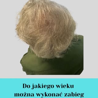 Wiek nie ogranicza pacjenta do wykonania zabiegu przeszczepu włosów czyli nie ma górnej  jego granic