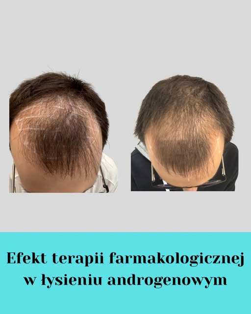 Łysienie androgenowe to postępująca androgenozależna postępująca utrata włosów .

W tego typu łysien