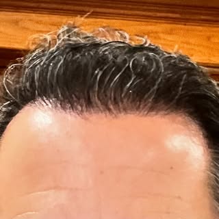 Quand six mois suffisent pour une métamorphose capillaire! 
De ‘peu de cheveux’ à ‘chevelure retrouv