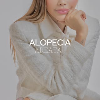 O que é a Alopecia Areata?
Trata-se de uma doença autoimune. Na prática, isso significa que o sistem