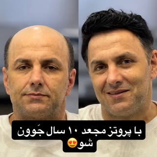 سلام
✅نصب تخصصی پروتز برای عزیزانی که از موهای کم پشت خود ناراضی هستند
✅بعد از سایزگیریی سر و نمونه 