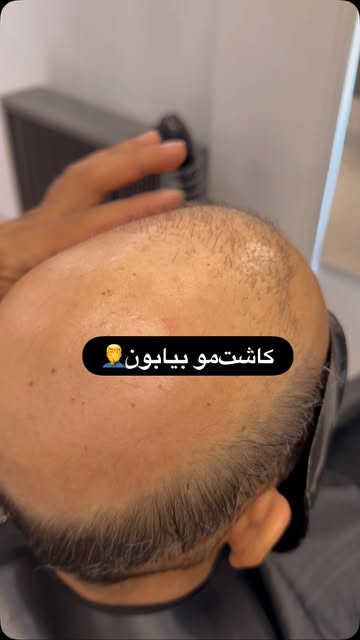 توی پستای بعد بهتون‌ توضیح میدم چه کسایی نباید کاشتمو انجام بدن👌

#پروتز #پروتز_دائمی_مو #پروتزمو_ط