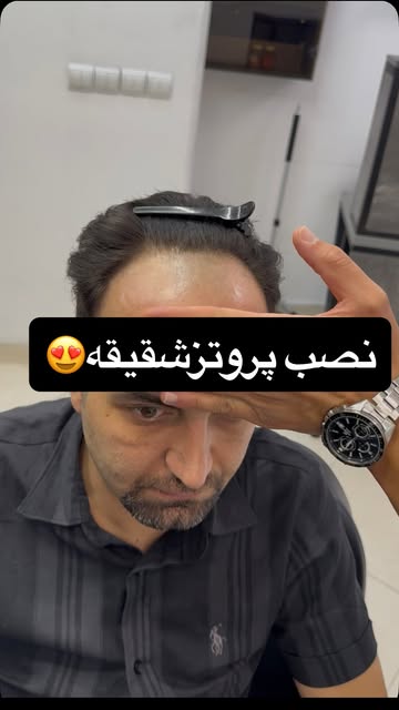 نصب پروتز شقیقه هم‌جنس موهای خودش😍

☎️09354148915
Follow:@iranporotez
Site:iranporotez.com

#پروتزم