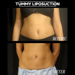 From stubborn fat to a more sculpted silhouette. ✨ 

This tummy liposuction transformation is all ab