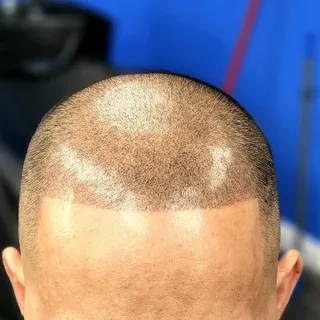 #scalpmicropigmentation #smp #hairloss #hairtattoo #headtatoo #scalppigmentation #smp #hairtransplan