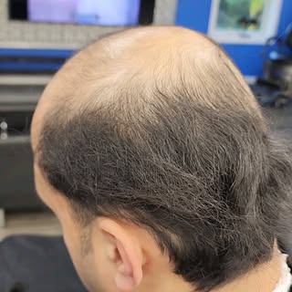 Scalp Micropigmentation.  Your hair loss solution!!! Royal SMP Solutions!!!! #scalpmicropigmentation