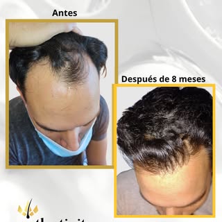 👨‍⚕️🙌 Resultados reales, con crecimiento natural 

A través de la técnica F.U.E, trabajamos utiliz