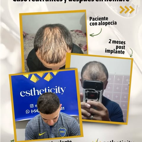 Franco llegó a Estheticity buscando una solución para su alopecia. Hoy compartimos la evolución de s