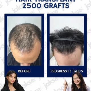 2.500 grafts, 1,5 tahun kemudian… 👀✨

Ini dia progress hair transplant dari kondisi rambut yang men