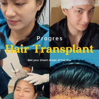 Ingin memiliki tampilan wajah yang lebih kecil? Sobat Jaksel bisa melakukan lowering hair line trans