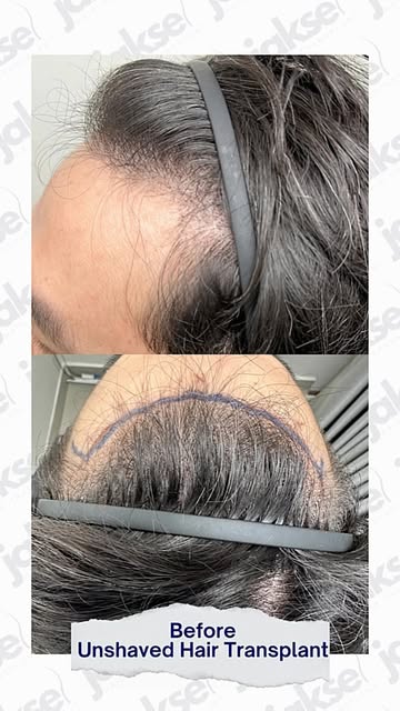 ✨ UNSHAVED HAIR TRANSPLANT — NATURAL RESULTS, WITHOUT SHAVING!

Ingin menjalani hair transplant tapi